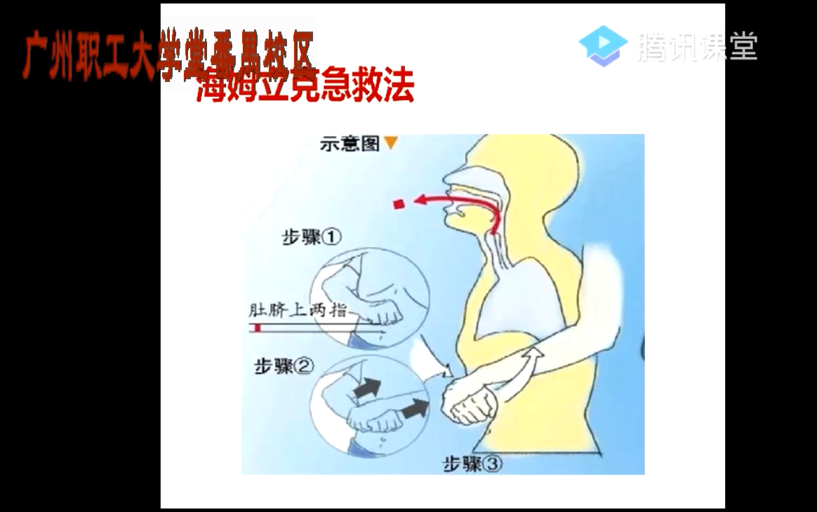 气道梗阻海姆立克急救法介绍及职工疑问解答